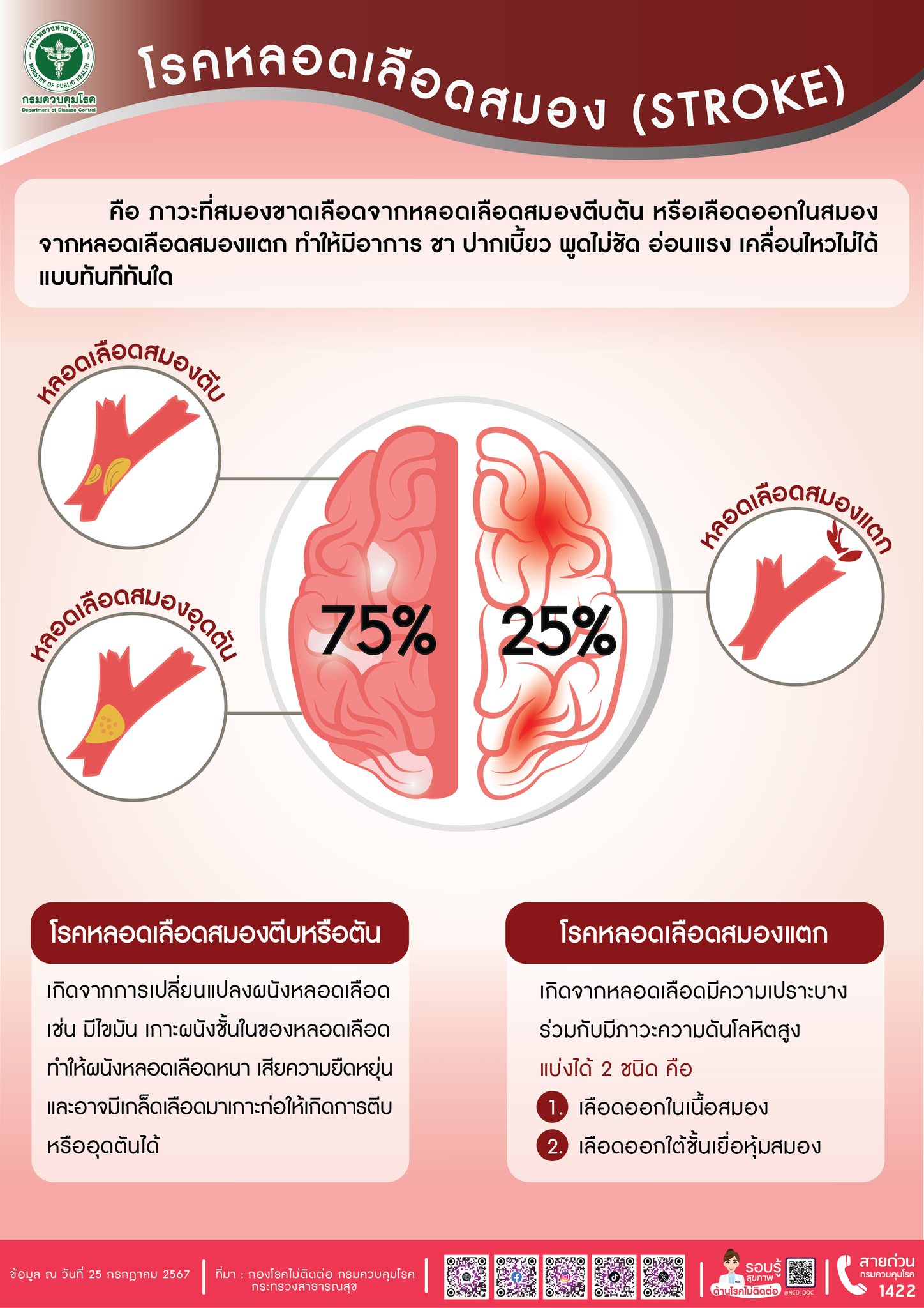 โรคหลอดเลือดสมอง