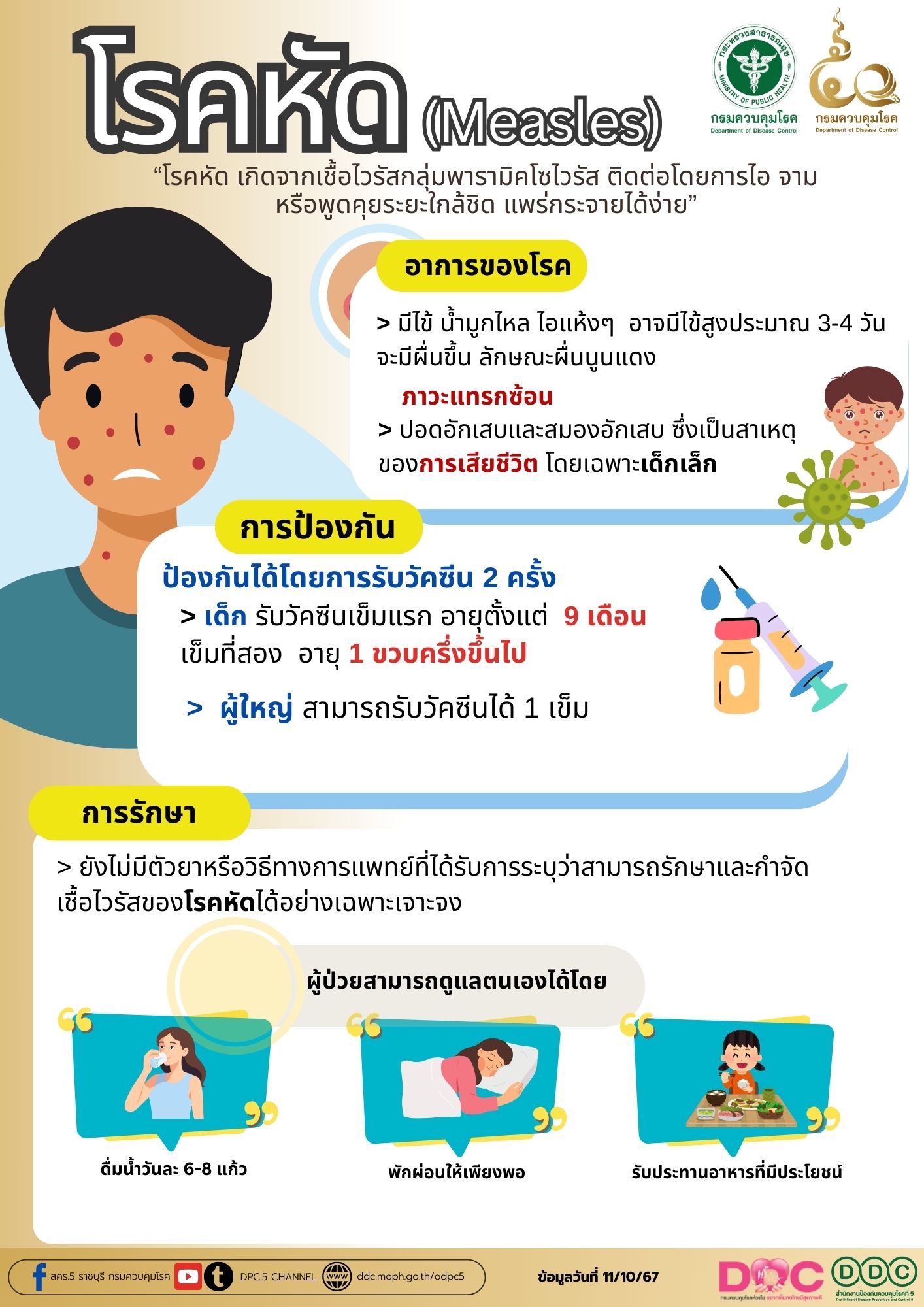 โรคหัด